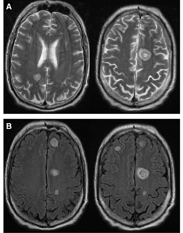 The man in his 50s had been battling an advanced form of prostate cancer for almost two years before seeking advice for his 'uncontrollable brogue'.  Pictured above are MRIs of the man's brain released by doctors at Duke University Health System.  A-scans are T2-weighted images, while B-scans are smooth attenuated inversion recovery images